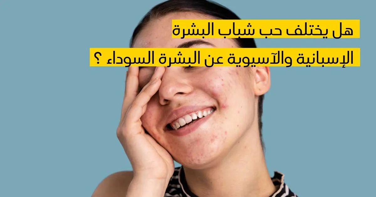  هل يختلف حب شباب البشرة الإسبانية والآسيوية عن البشرة السوداء ؟